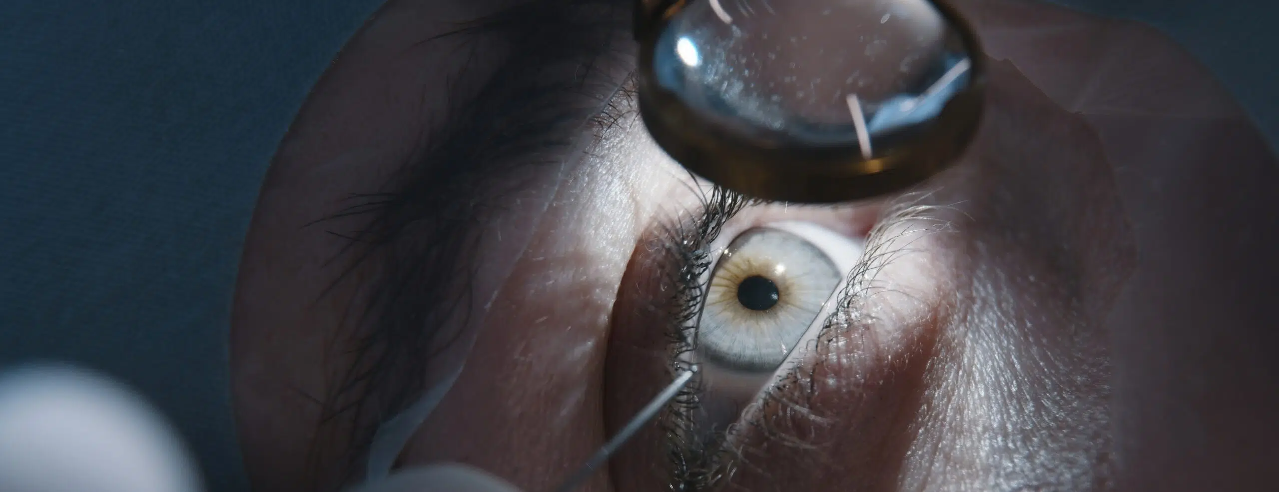 Infection après chirurgie réfractive (LASIK, PKR, SMILE) : Quels sont les risques réels ?