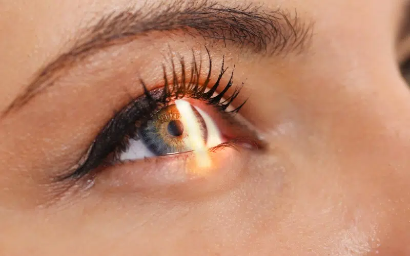 Comparatif PKR, LASIK, SMILE.