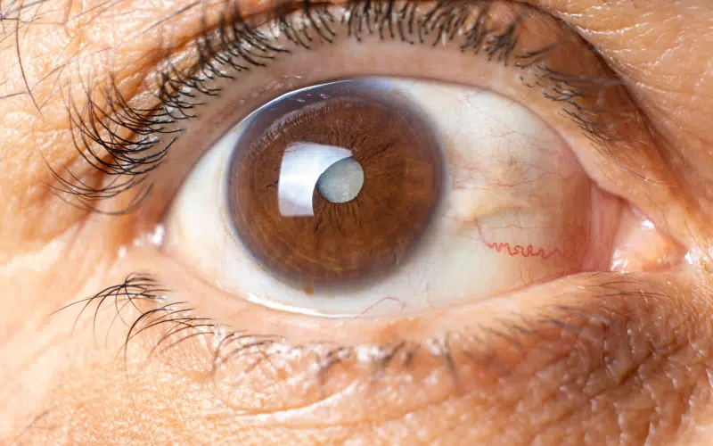 Cataracte