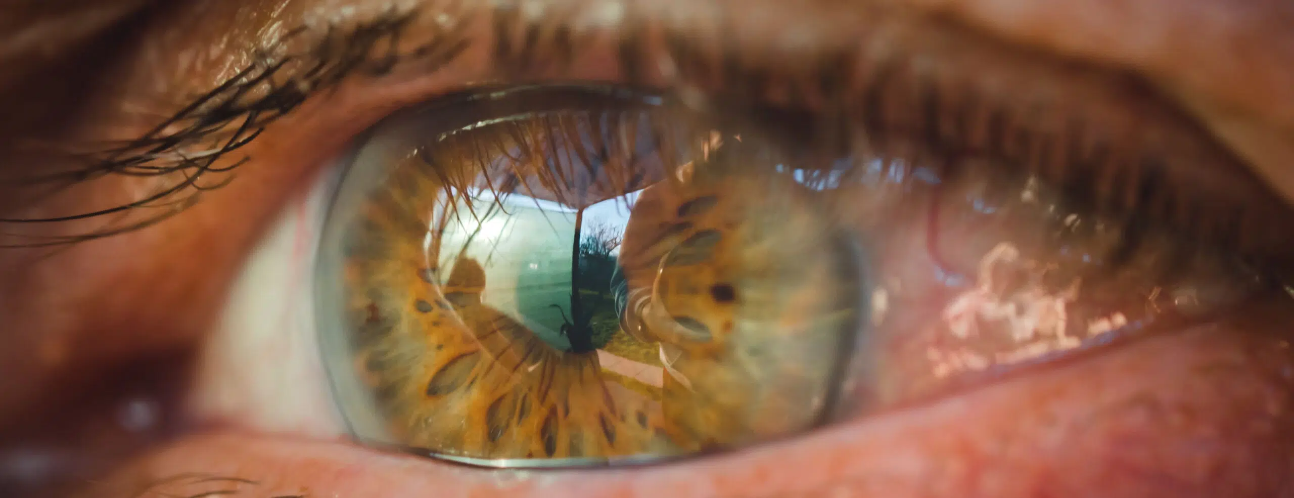 Implants toriques : corriger l’astigmatisme lors de la chirurgie de la cataracte