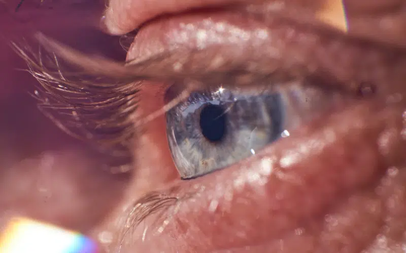 Implants de cataracte | Dr Stacy Charpentier | Paris