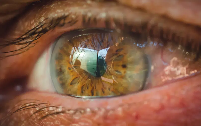 Implants toriques | Dr Stacy Charpentier | Paris