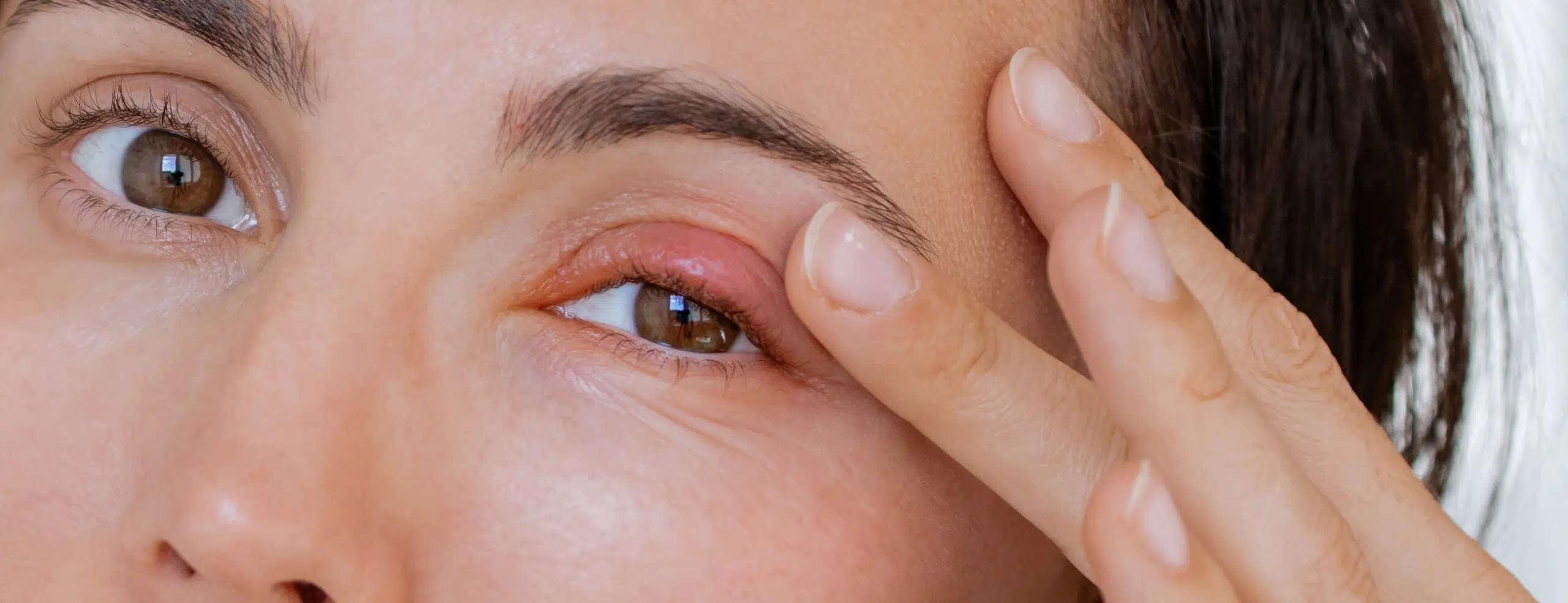 Orgelet ou chalazion : quelles différences ?