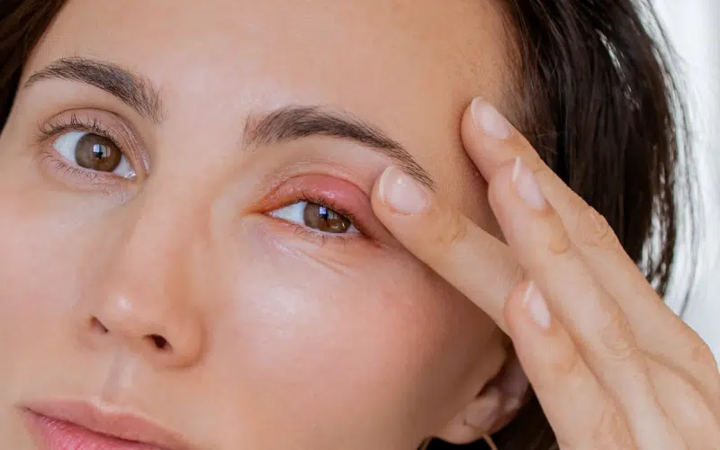 Orgelet et chalazion | Dr Stacy Charpentier | Paris